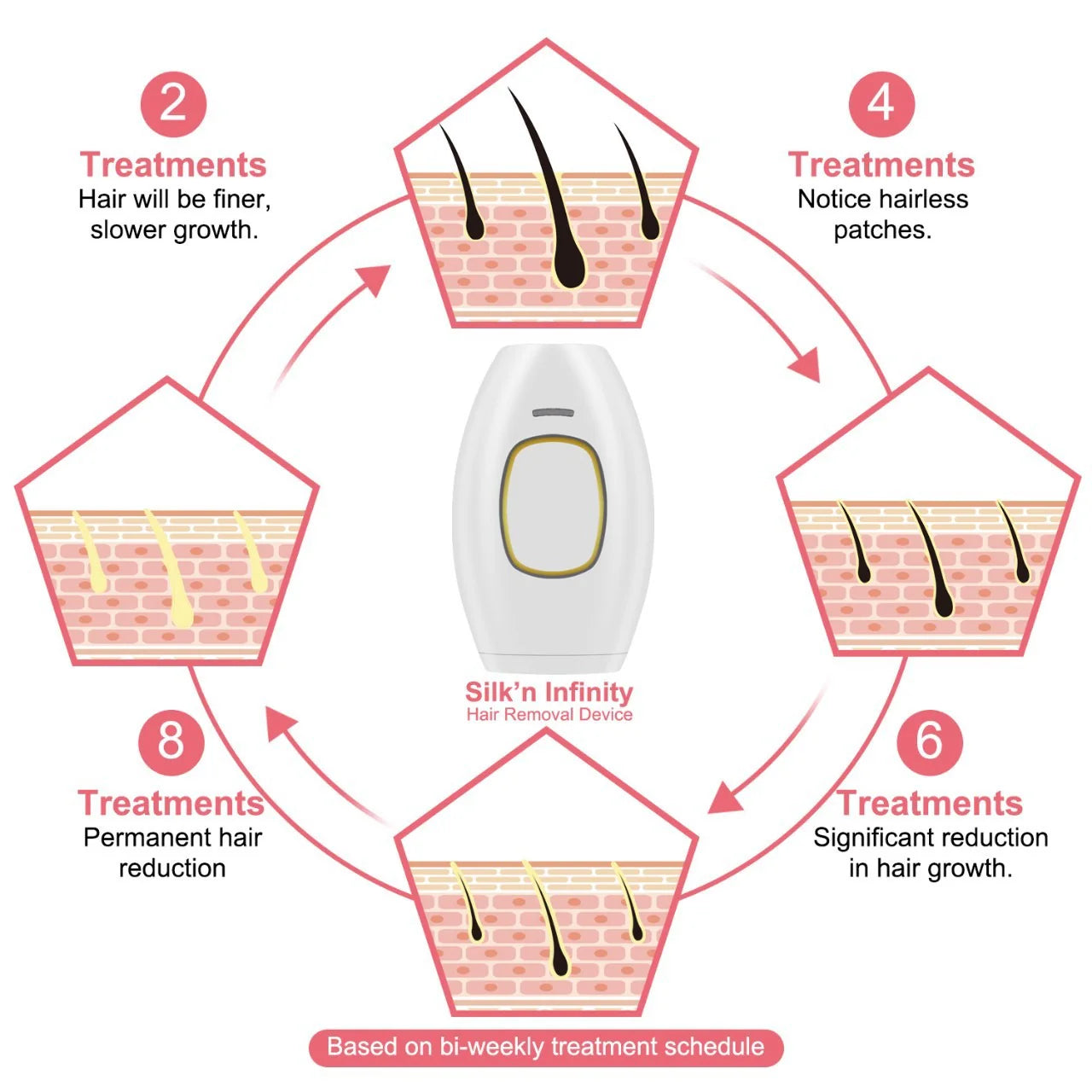 IPL Hair Removal (Women)